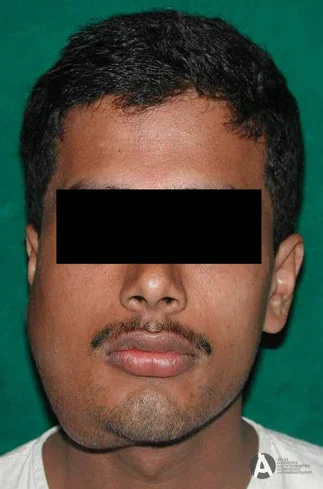 Dr Manish Tiwari Ameloblastoma Jaw Surgeon