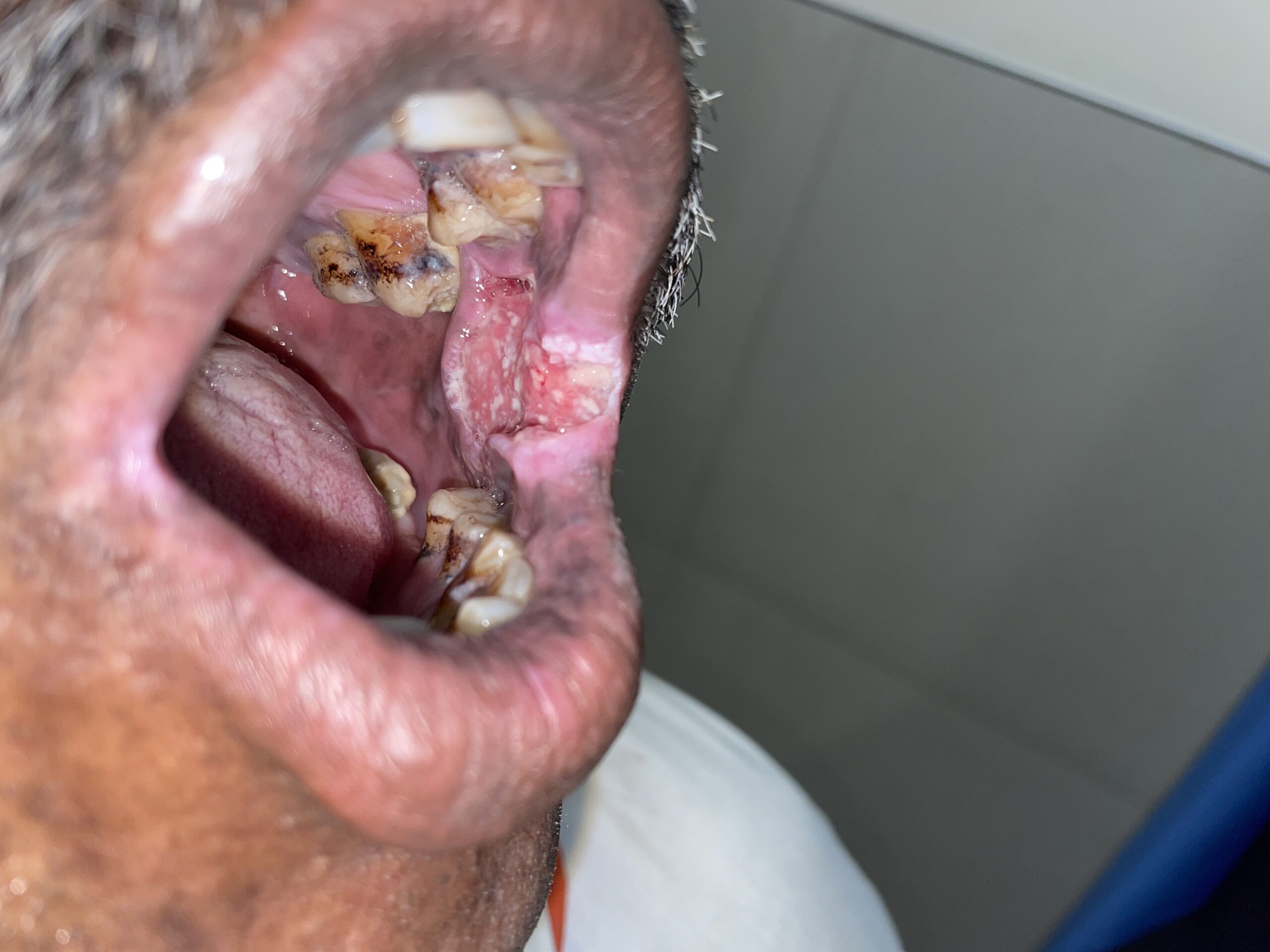 Dr Manish Tiwari Buccal Mucosa Cancer Surgeon