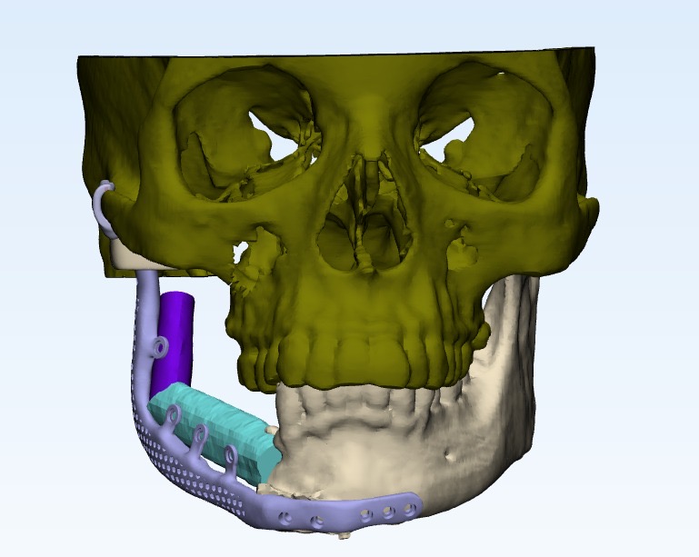 Microvascular Free Flap Surgery