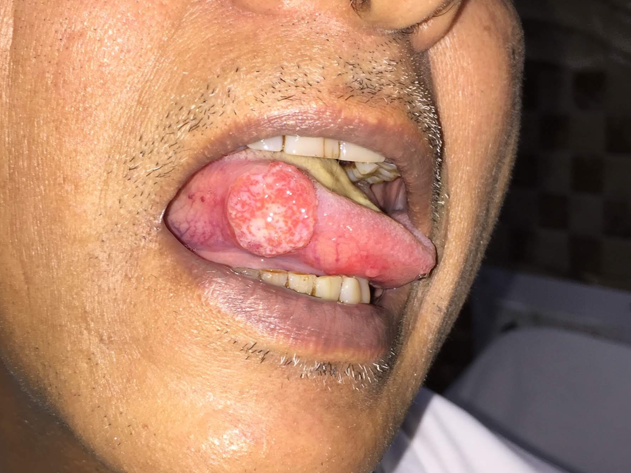 Microvascular Reconstruction Surgery