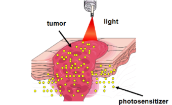 Dr Manish Tiwari Photodynamic Therapy Expert