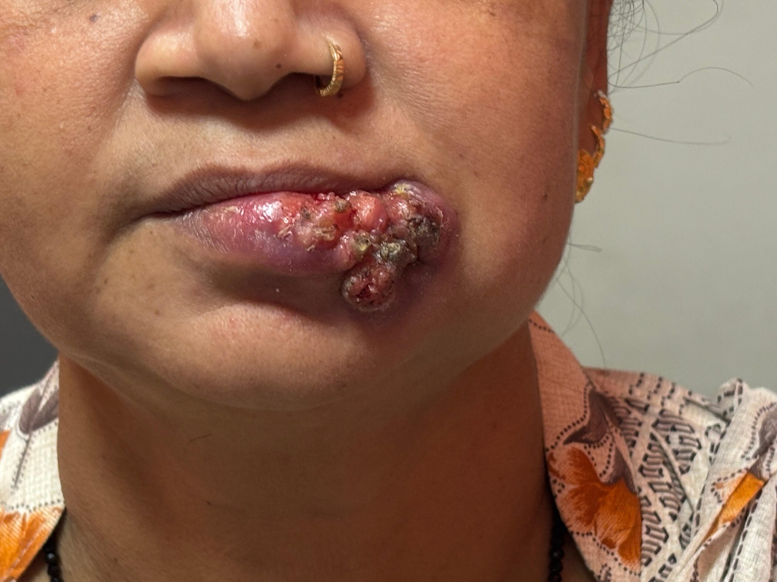 Dr Manish Tiwari Lip and Palate Cancer Surgeon