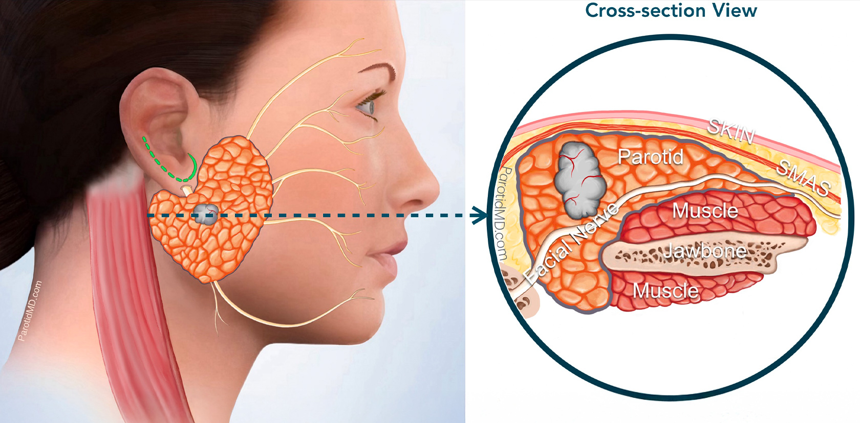 Dr Manish Tiwari Parotid Reconstruction Surgeon