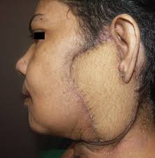 Dr Manish Tiwari ALT Flap Microvascular Surgeon